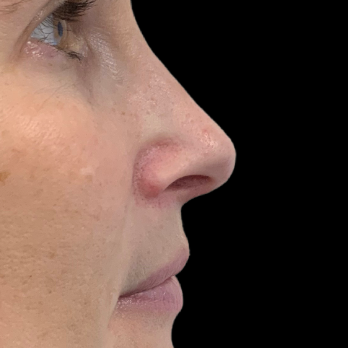 Ultrasonic-rhinoplasty-after